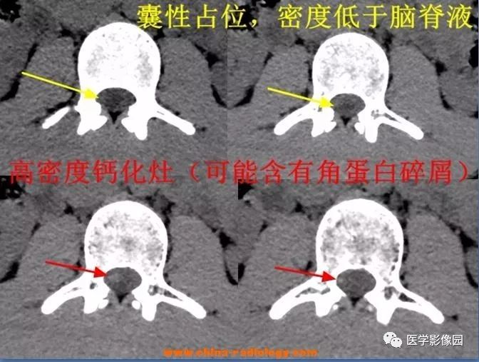 【病例】椎管内囊性占位—皮样囊肿1例MR影像表现