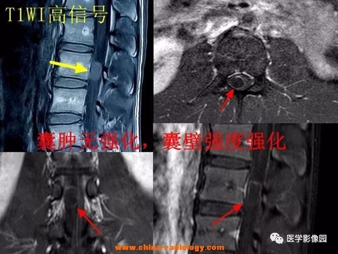 【病例】椎管内囊性占位—皮样囊肿1例MR影像表现