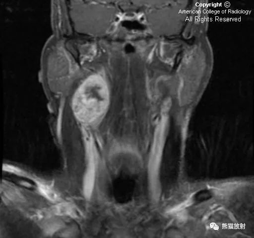 【病例】颈部迷走神经鞘瘤1例CT及MR影像表现 【病例】颈部迷走神经鞘瘤1例CT及MR影像表现