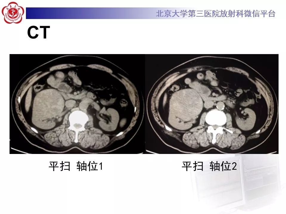 【病例】肾脏嫌色细胞癌1例CT影像表现