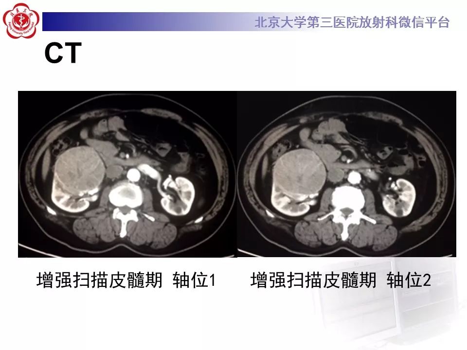 【病例】肾脏嫌色细胞癌1例CT影像表现