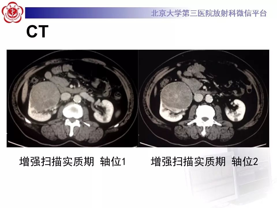 【病例】肾脏嫌色细胞癌1例CT影像表现