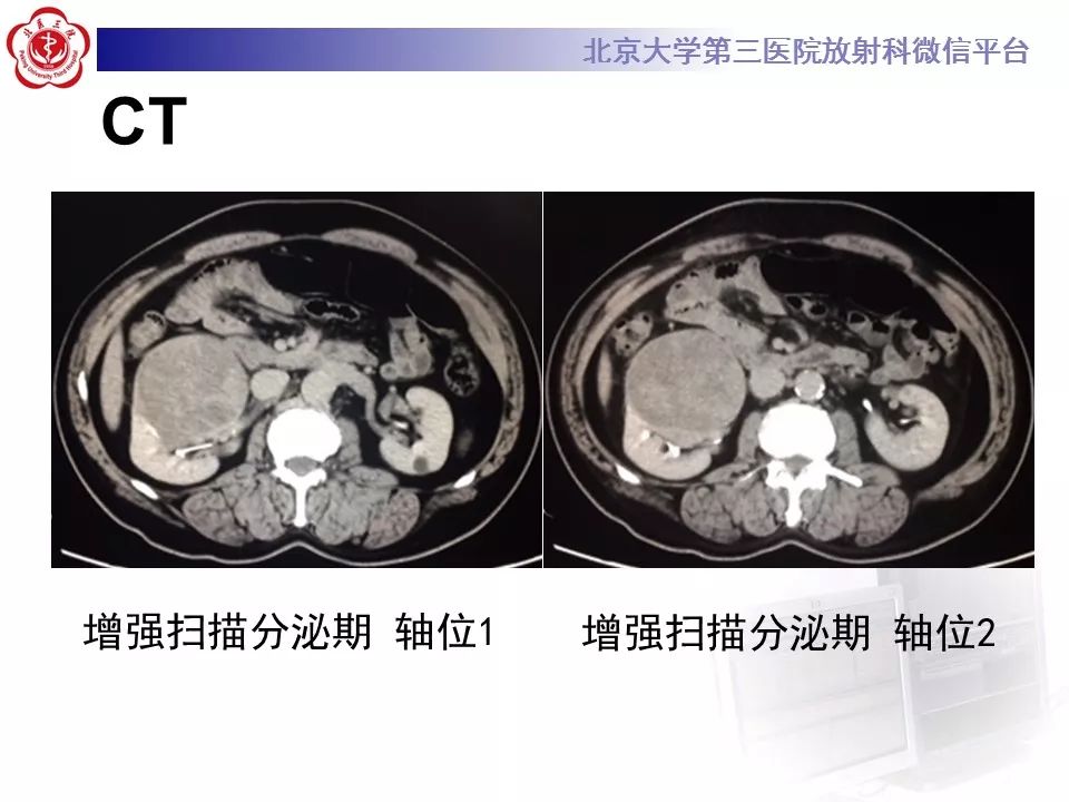 【病例】肾脏嫌色细胞癌1例CT影像表现