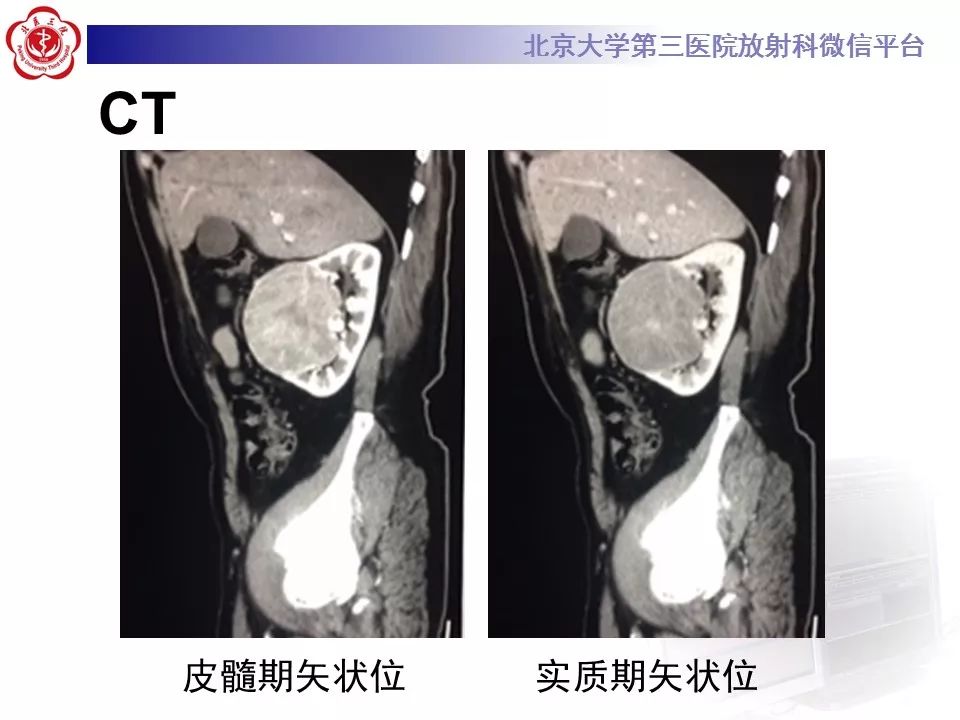 【病例】肾脏嫌色细胞癌1例CT影像表现