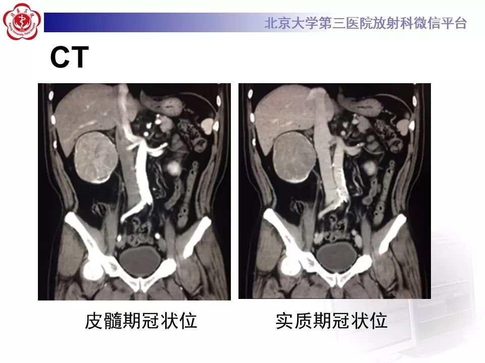 【病例】肾脏嫌色细胞癌1例CT影像表现