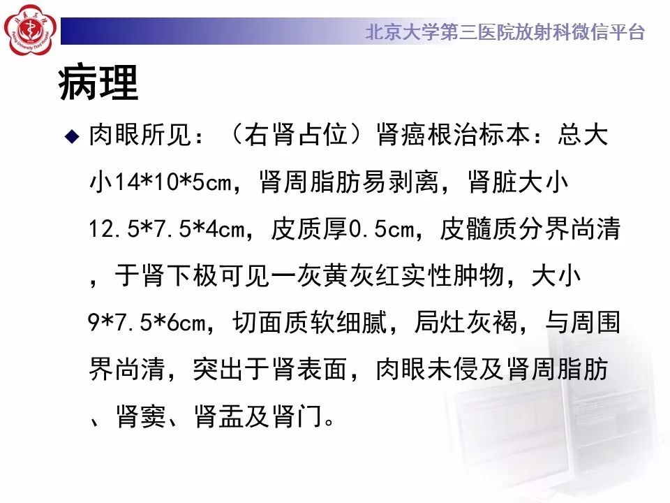 【病例】肾脏嫌色细胞癌1例CT影像表现