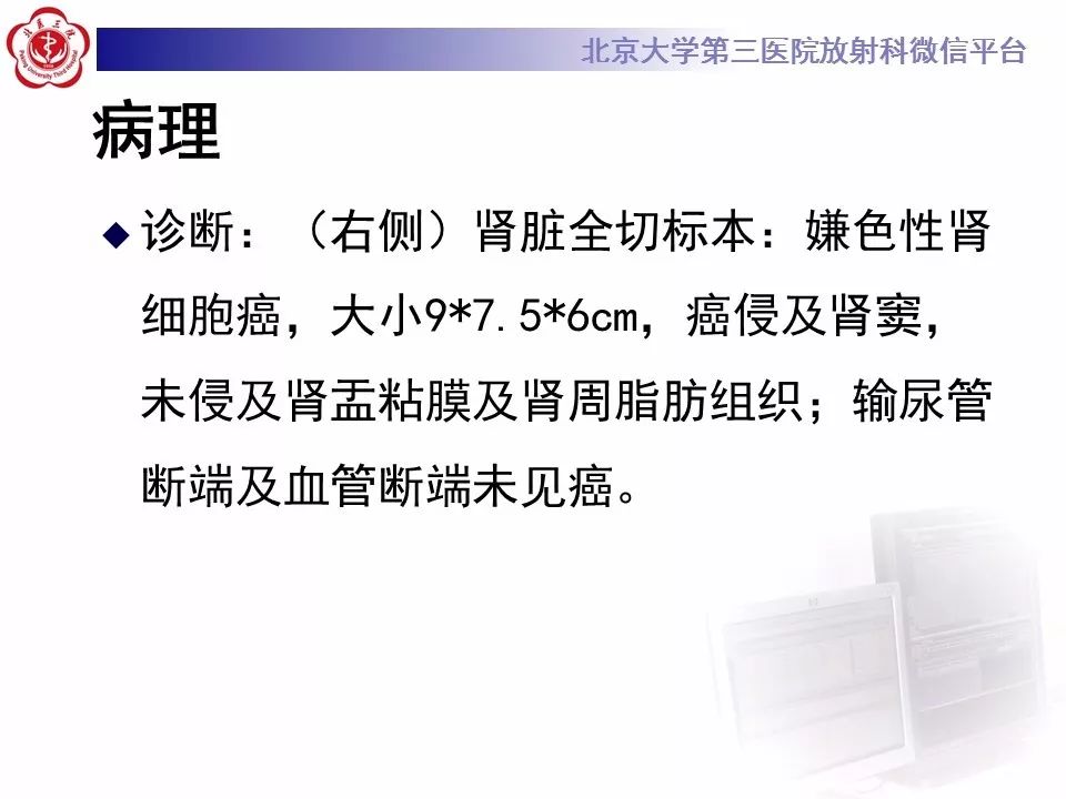 【病例】肾脏嫌色细胞癌1例CT影像表现