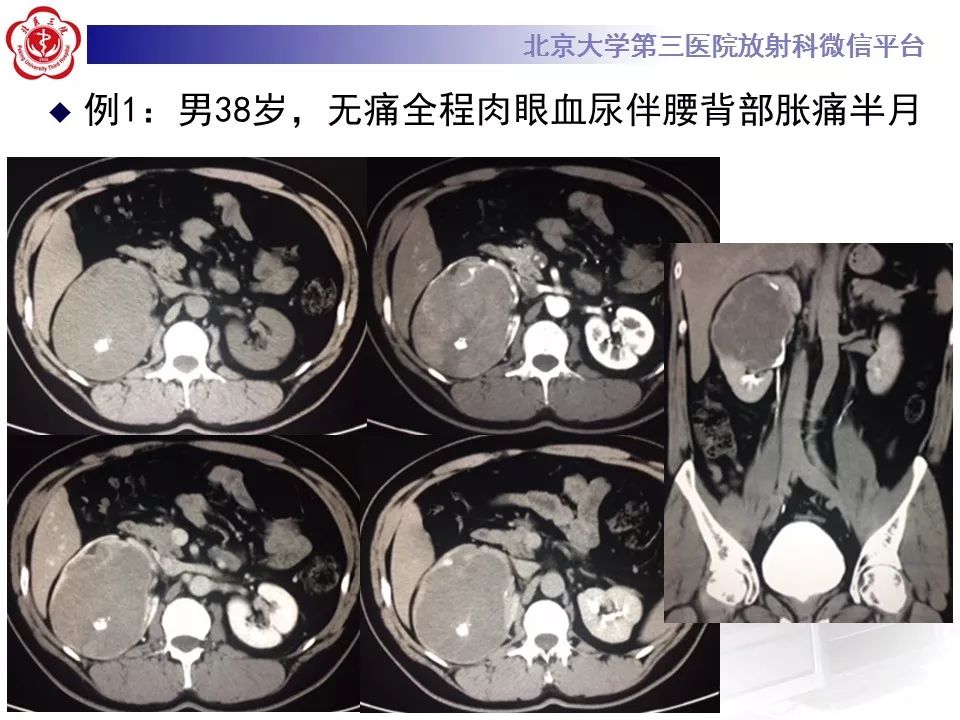 【病例】肾脏嫌色细胞癌1例CT影像表现