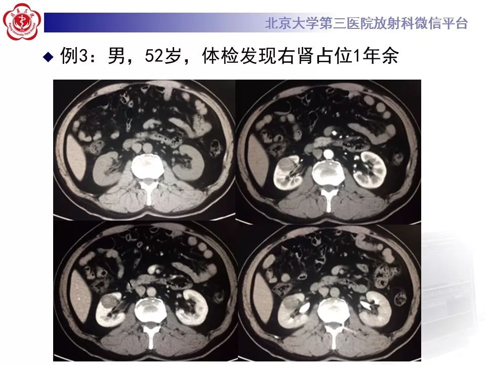 【病例】肾脏嫌色细胞癌1例CT影像表现