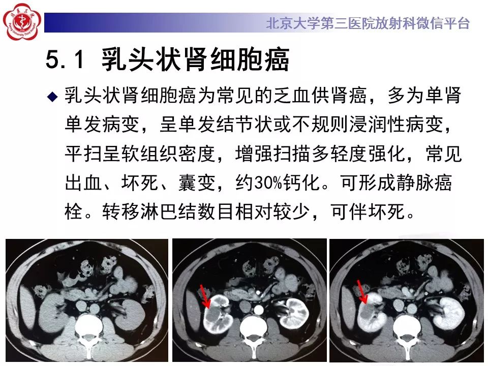 【病例】肾脏嫌色细胞癌1例CT影像表现