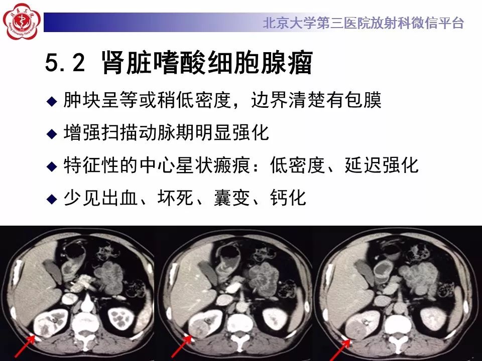 【病例】肾脏嫌色细胞癌1例CT影像表现
