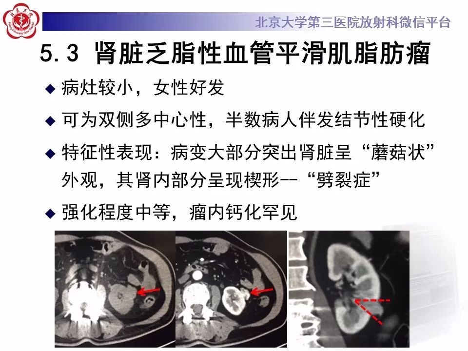 【病例】肾脏嫌色细胞癌1例CT影像表现