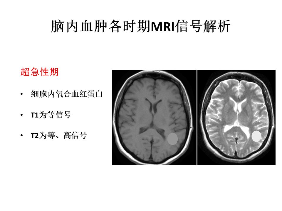 【PPT】脑出血MRI信号的演变