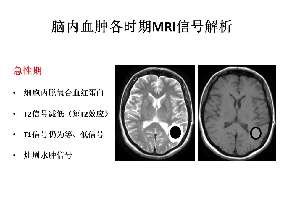 【PPT】脑出血MRI信号的演变