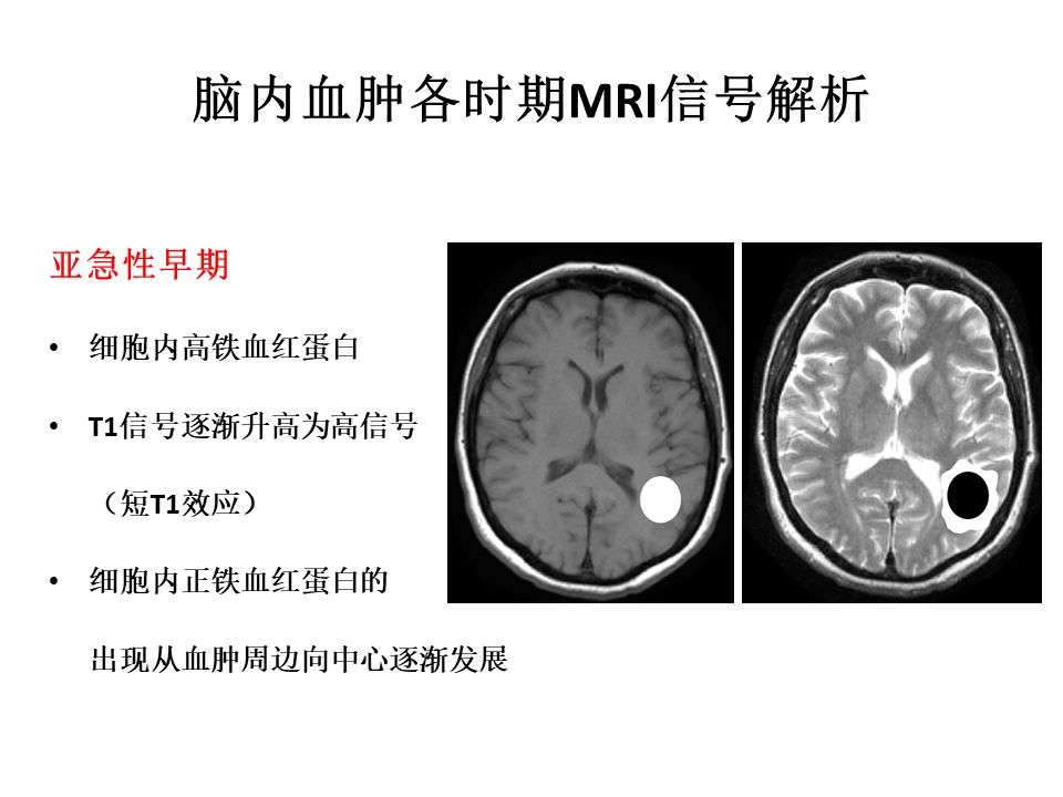 【PPT】脑出血MRI信号的演变