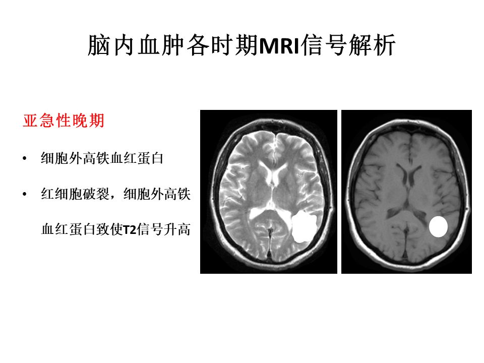 【PPT】脑出血MRI信号的演变