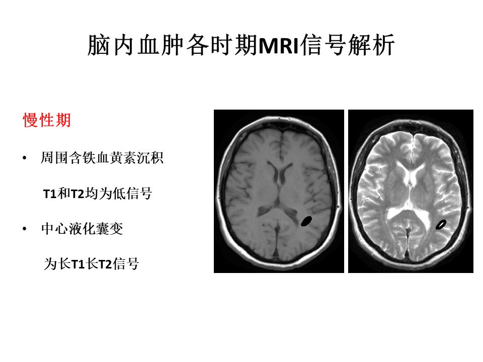 【PPT】脑出血MRI信号的演变