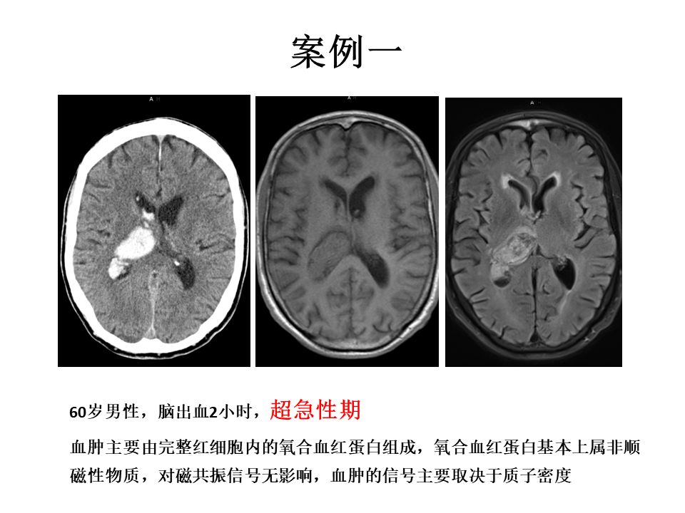 【PPT】脑出血MRI信号的演变