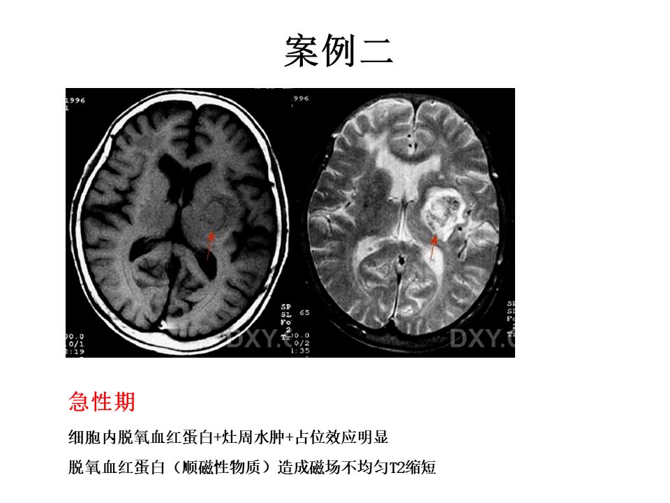 【PPT】脑出血MRI信号的演变