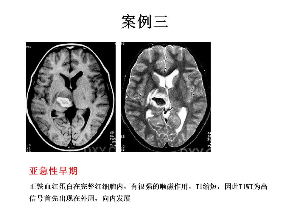 【PPT】脑出血MRI信号的演变