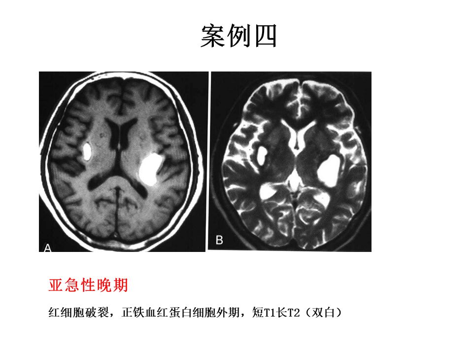 【PPT】脑出血MRI信号的演变