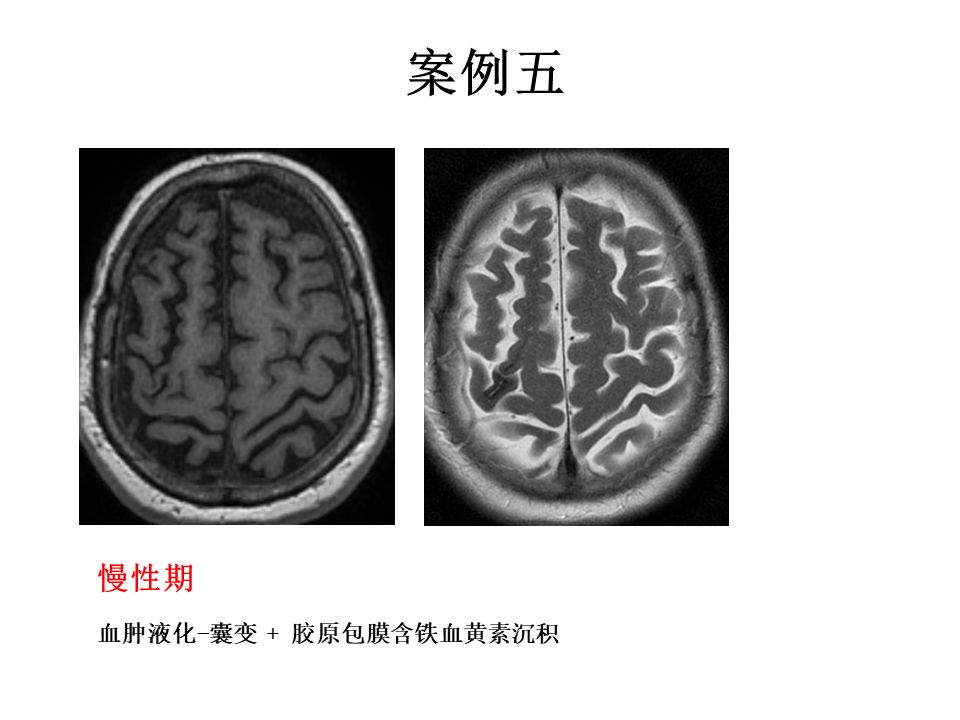 【PPT】脑出血MRI信号的演变