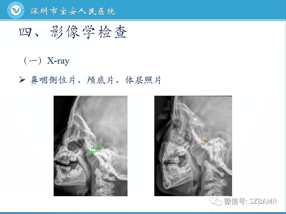 【PPT】鼻咽癌影像诊断