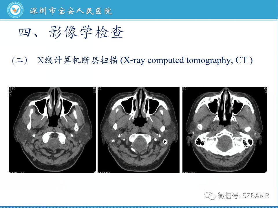 【PPT】鼻咽癌影像诊断