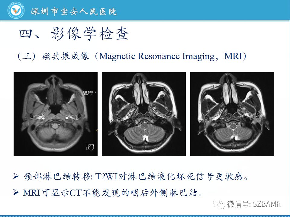 【PPT】鼻咽癌影像诊断