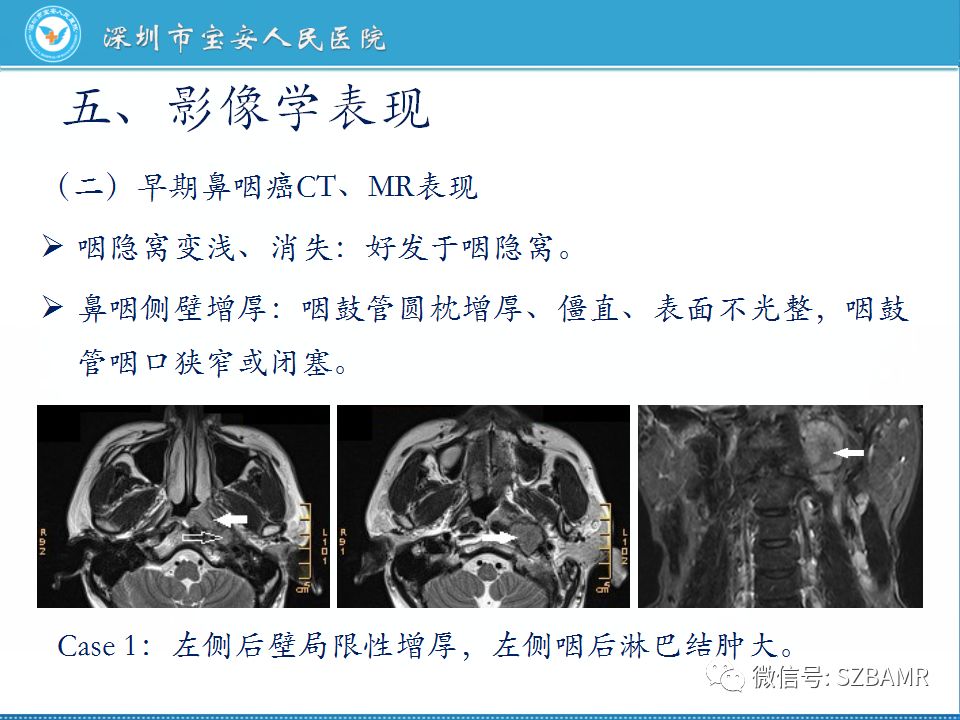 【PPT】鼻咽癌影像诊断