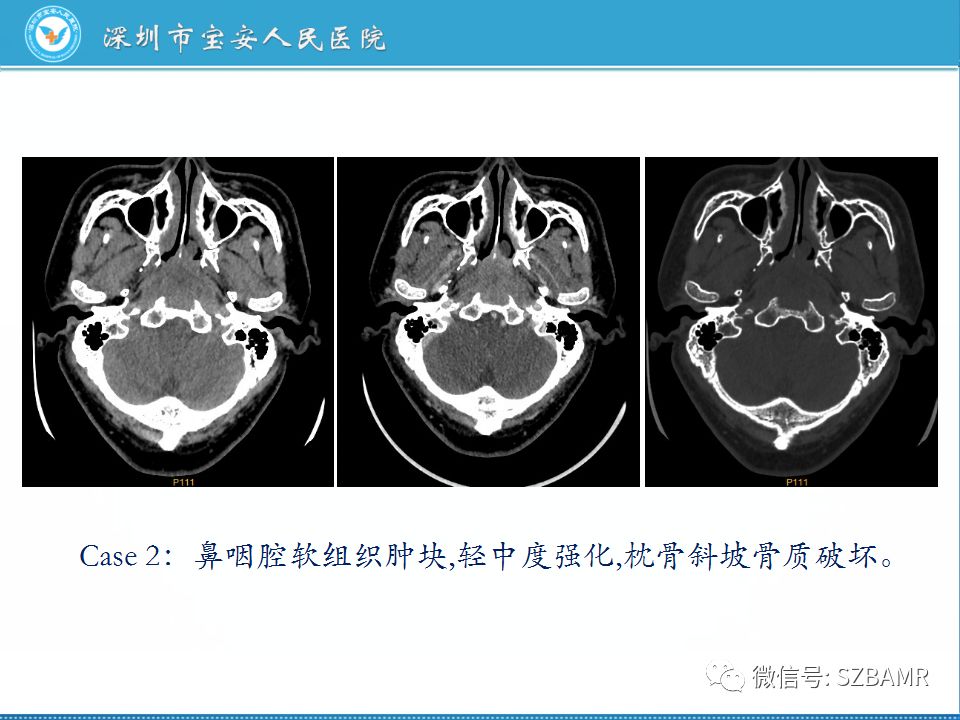 【PPT】鼻咽癌影像诊断