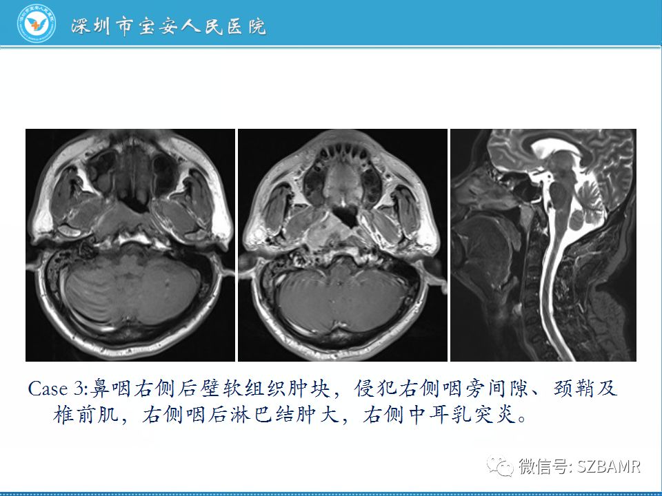 【PPT】鼻咽癌影像诊断