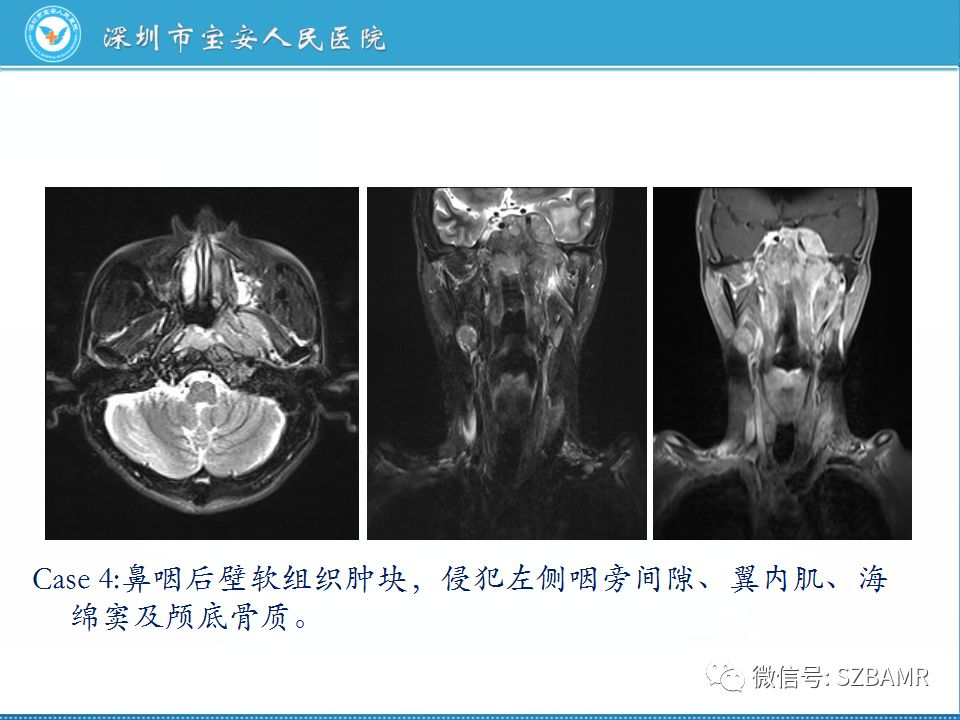 【PPT】鼻咽癌影像诊断
