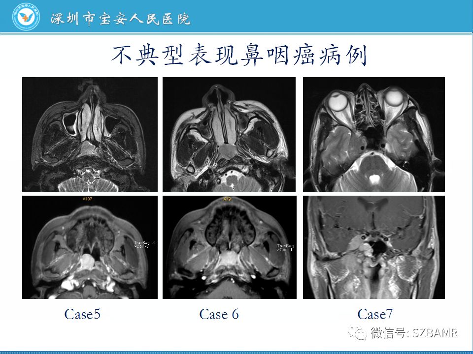 【PPT】鼻咽癌影像诊断