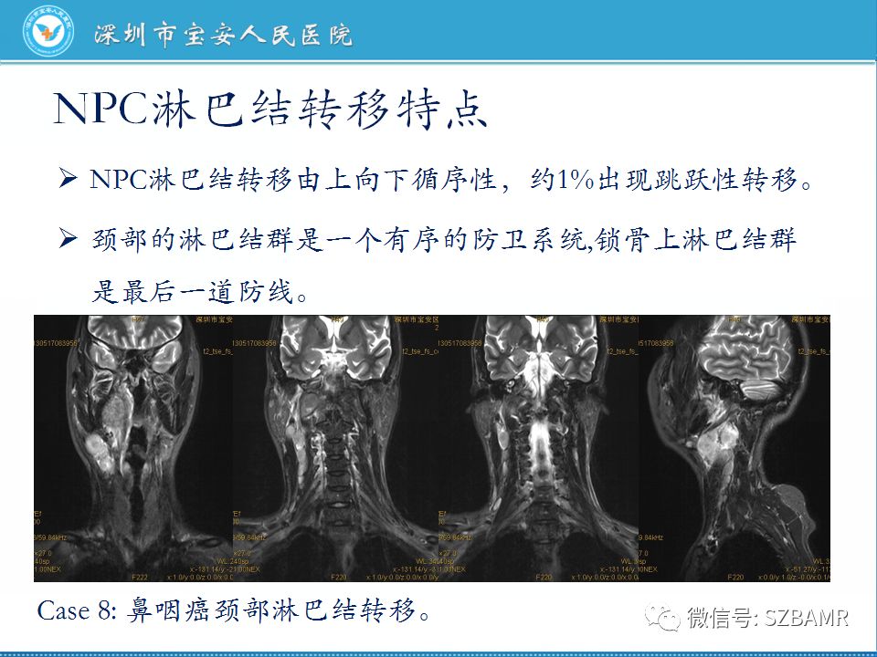 【PPT】鼻咽癌影像诊断