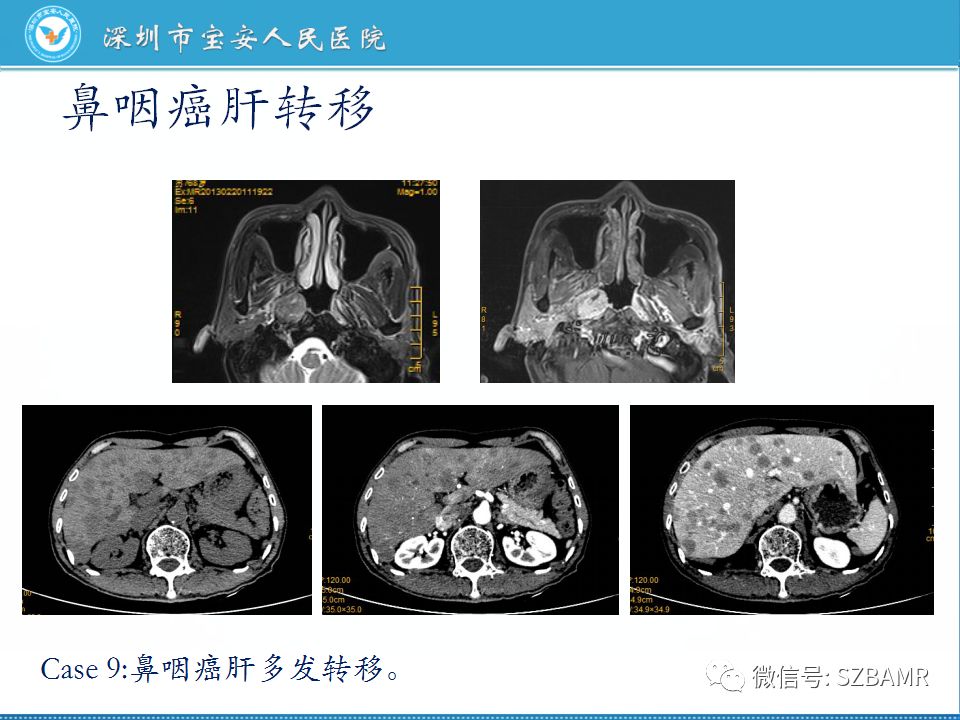 【PPT】鼻咽癌影像诊断