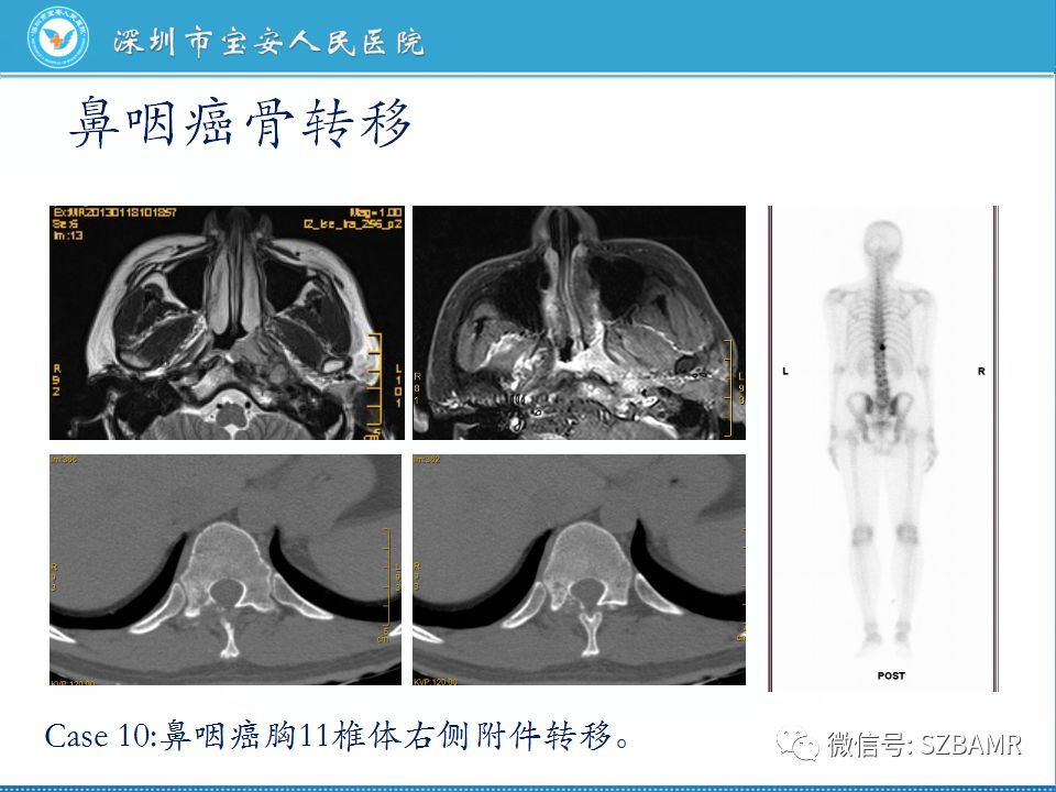 【PPT】鼻咽癌影像诊断