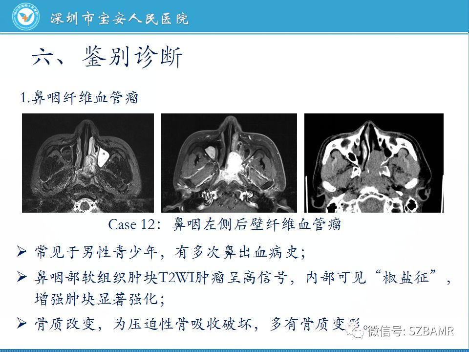 【PPT】鼻咽癌影像诊断