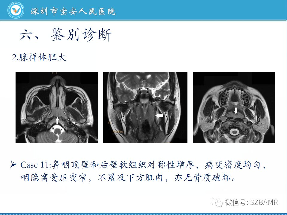 【PPT】鼻咽癌影像诊断