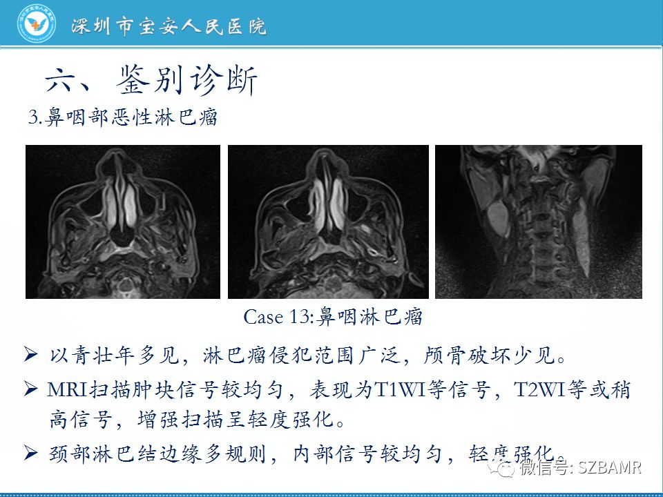 【PPT】鼻咽癌影像诊断