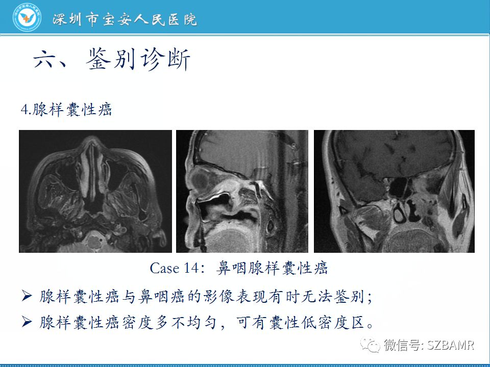 【PPT】鼻咽癌影像诊断