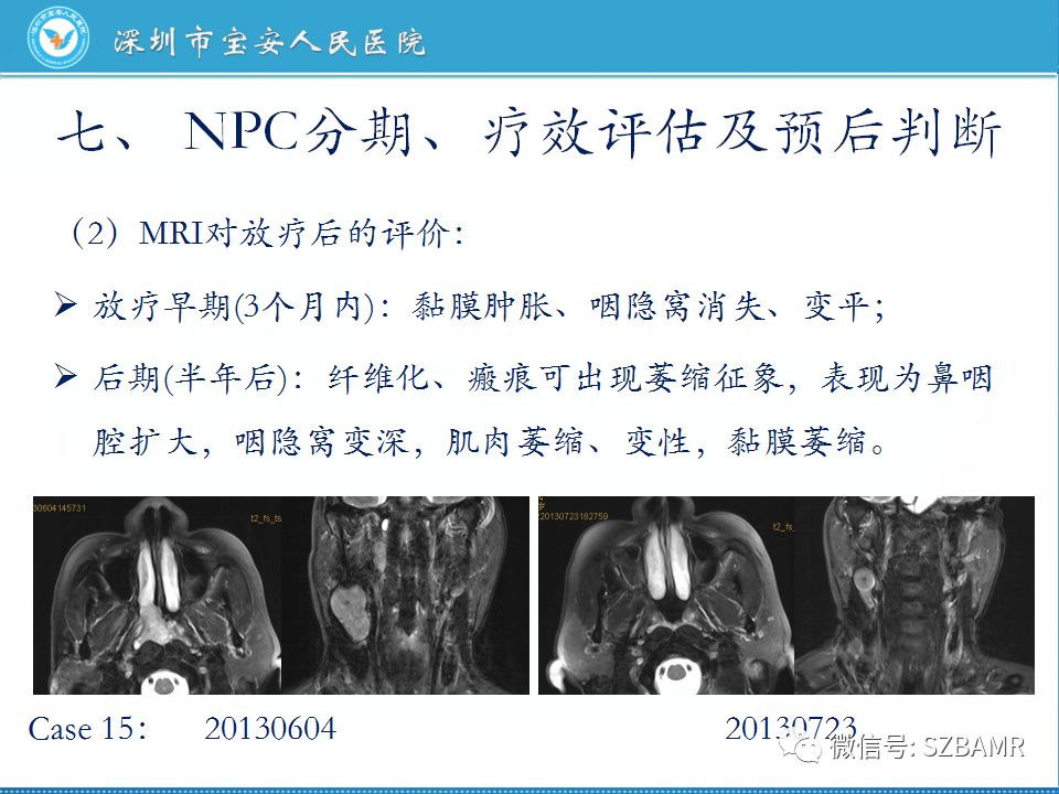 【PPT】鼻咽癌影像诊断