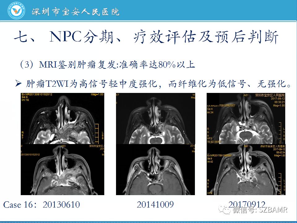 【PPT】鼻咽癌影像诊断