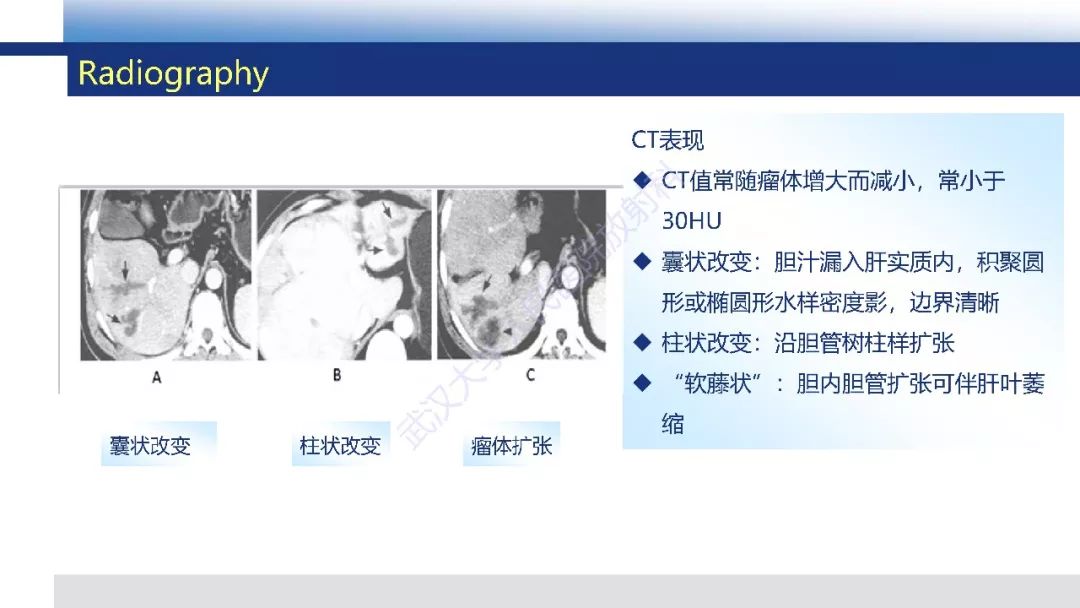 【PPT】胆汁瘤影像诊断与临床