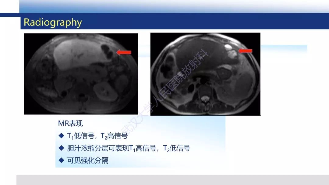 【PPT】胆汁瘤影像诊断与临床