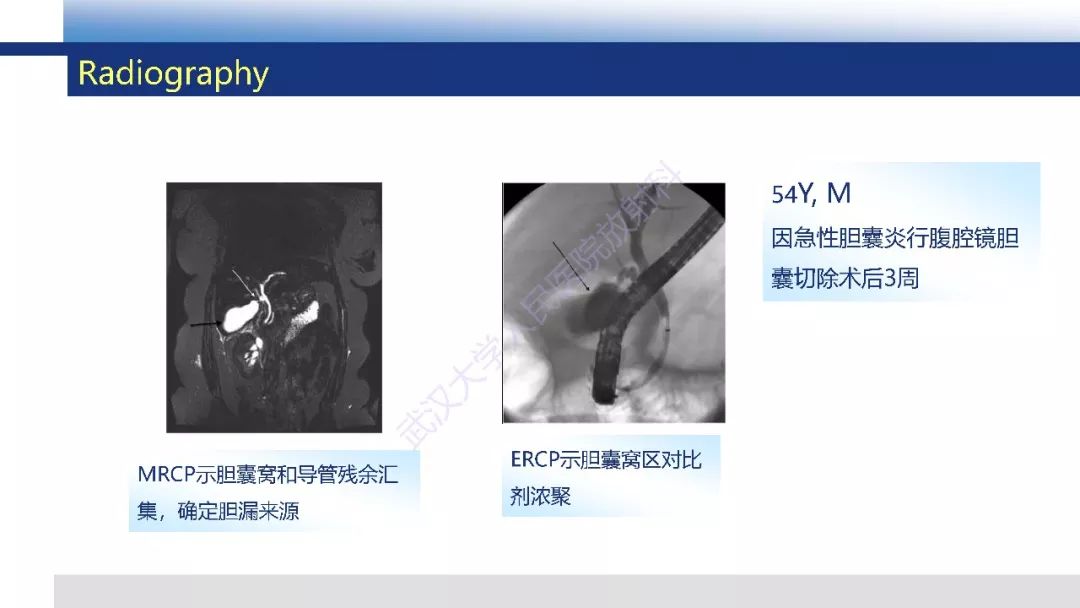 【PPT】胆汁瘤影像诊断与临床
