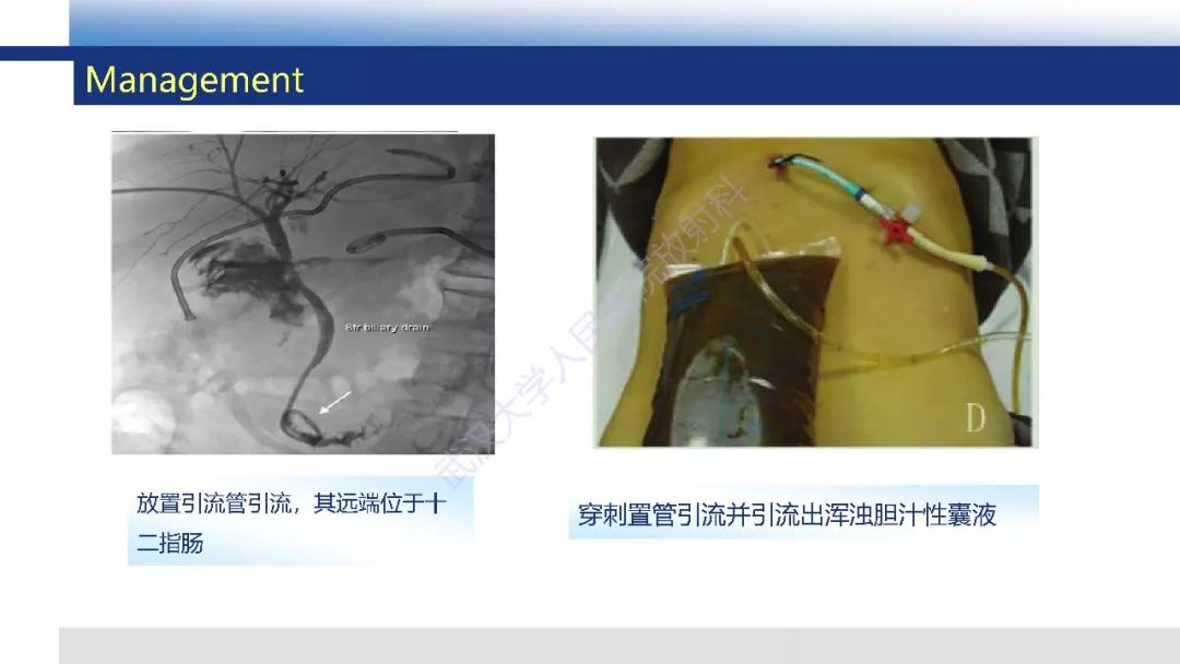【PPT】胆汁瘤影像诊断与临床