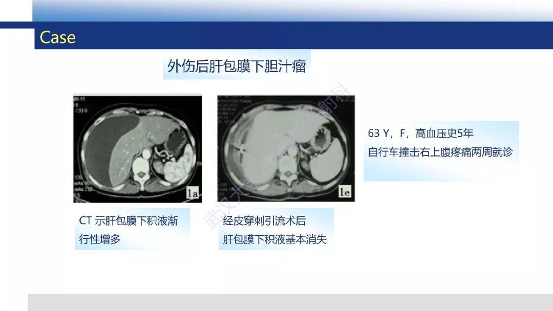 【PPT】胆汁瘤影像诊断与临床