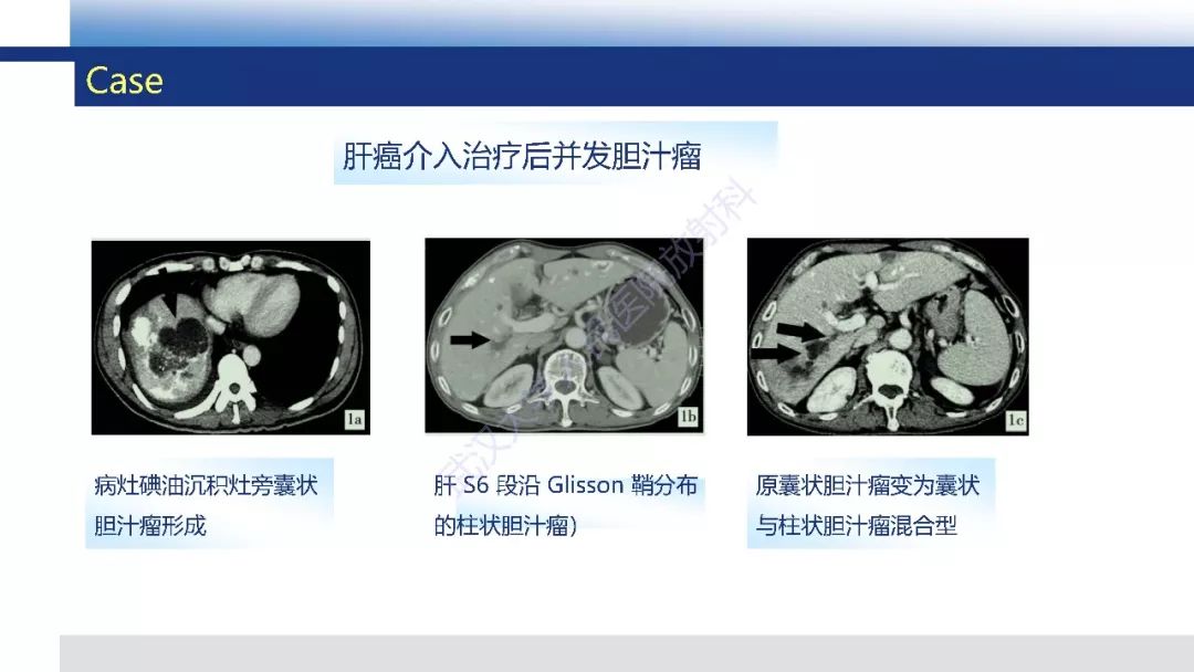 【PPT】胆汁瘤影像诊断与临床
