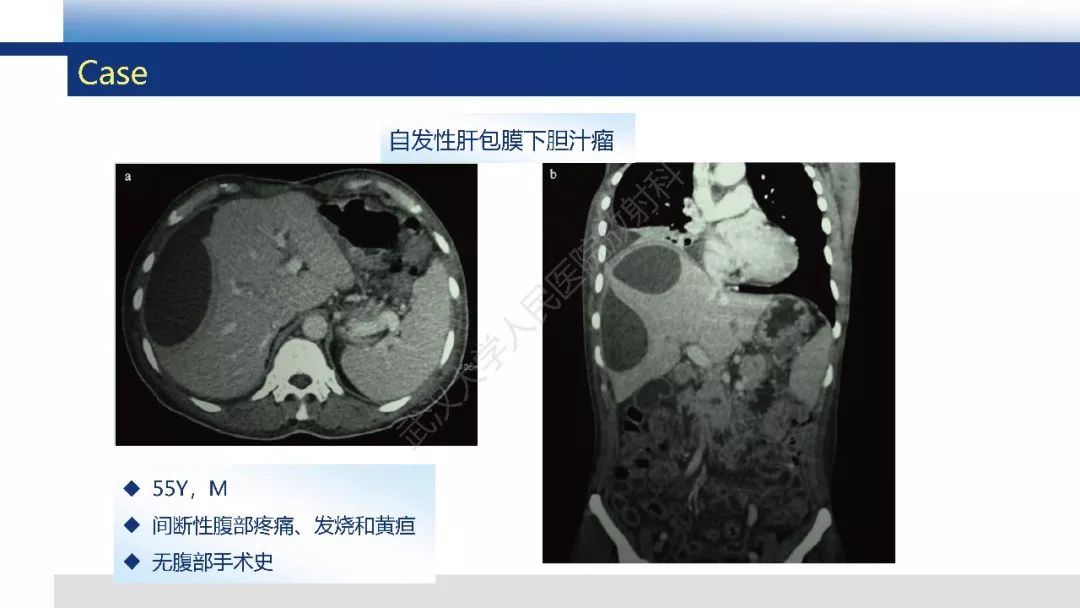 【PPT】胆汁瘤影像诊断与临床